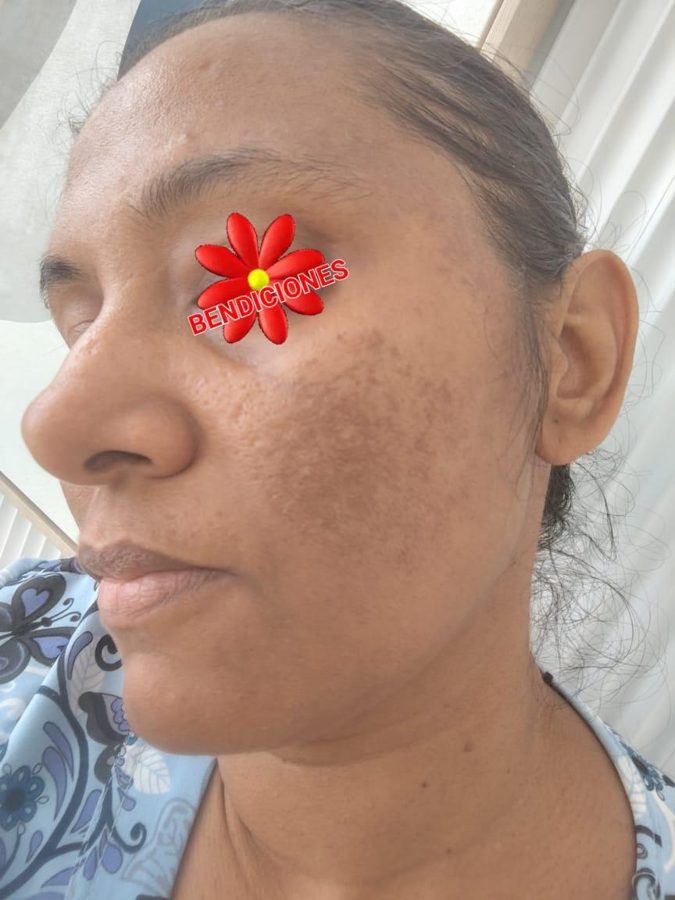 Antes y despues paciente 5 Vanessa Beauty Studio