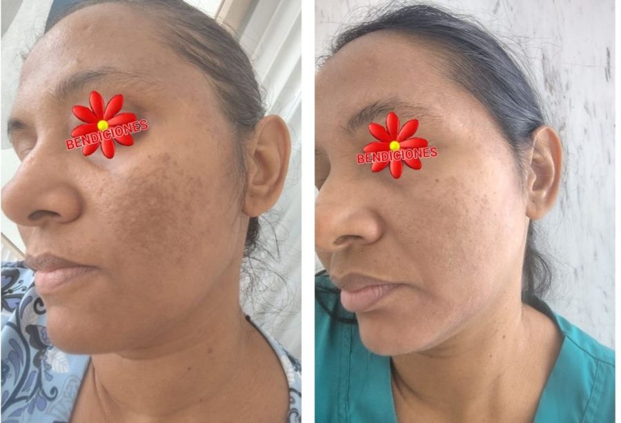 Antes y despues paciente 6 Vanessa Beauty Studio