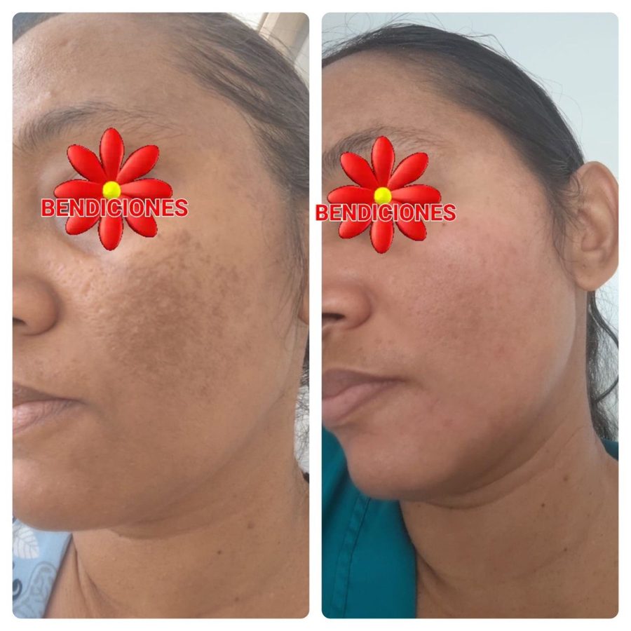 Antes y despues paciente 7 Vanessa Beauty Studio
