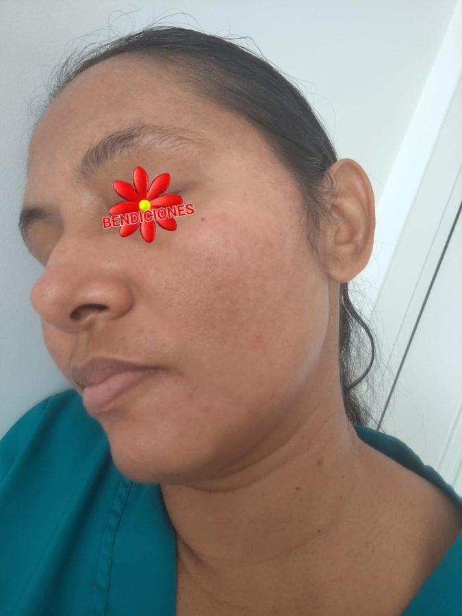 Antes y despues paciente 8 Vanessa Beauty Studio