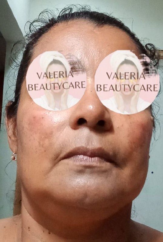 Antes y despues paciente 10 Vanessa Beauty Studio